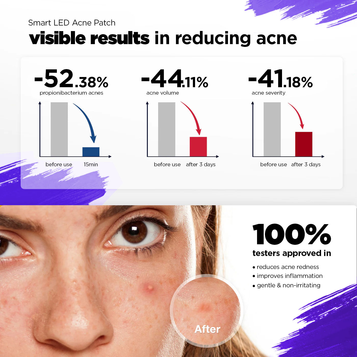 GlowUp Acne LED Patch graphic showing visible results in reducing acne with graphs and a close-up of a person's face.