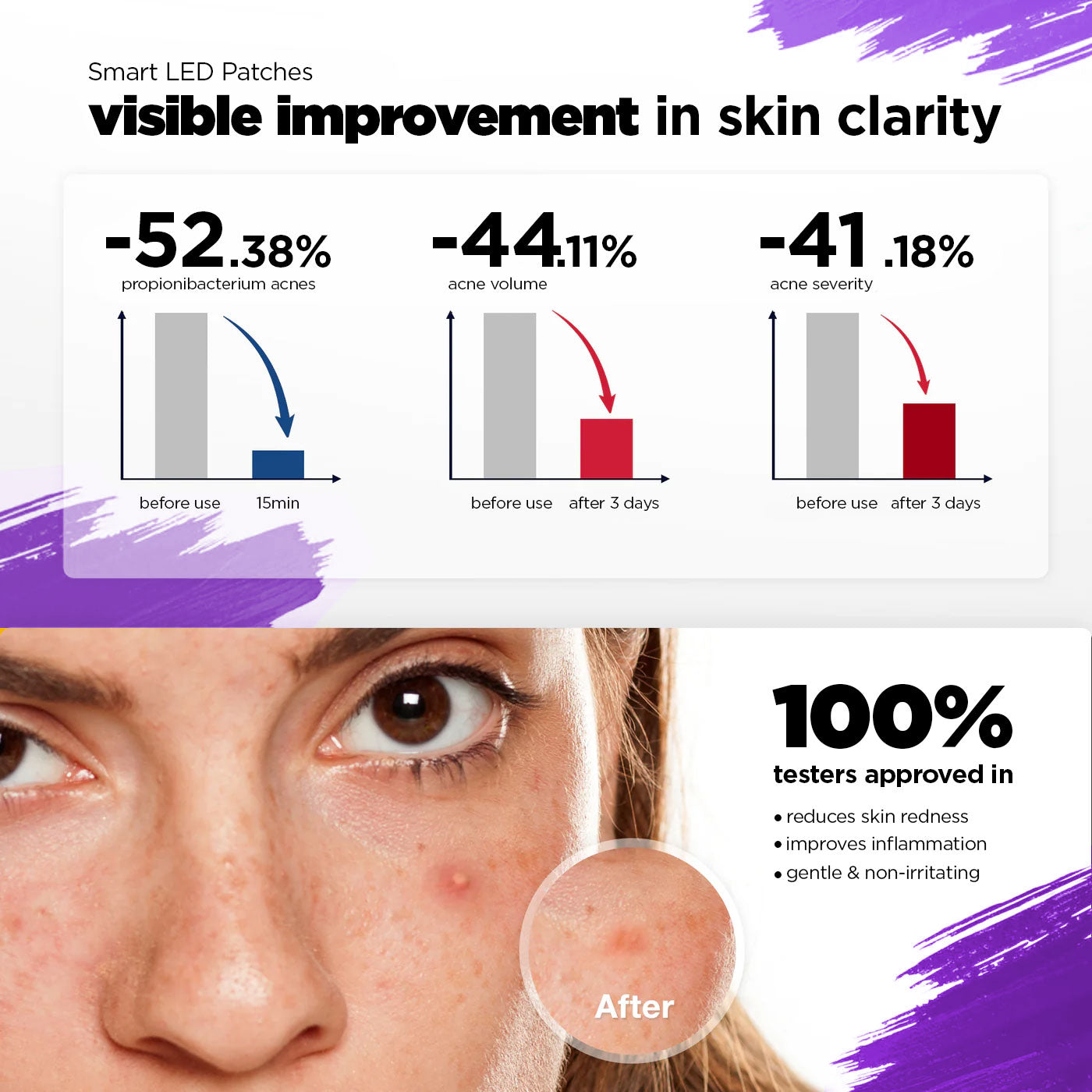 GlowUp Acne LED Patch graphic showing visible results in reducing acne with graphs and a close-up of a person's face.